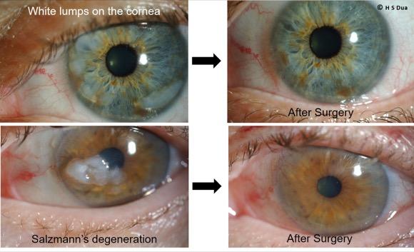 Superficial Keratectomy and Excision of Lesions. Eye surgeon in Nottingham.